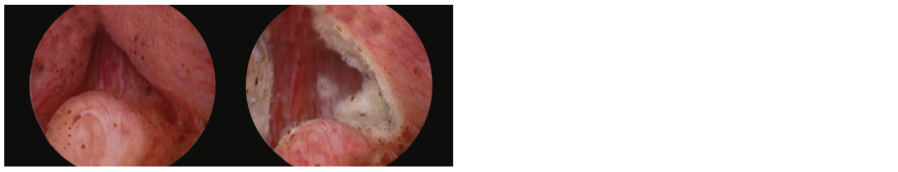 2 scope images. Identifying anatomical landmarks (image shows left ureteral orifice).