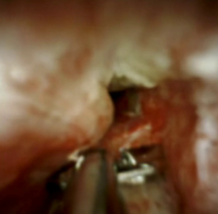 Clinical image of SpyBite 2 (DS II).