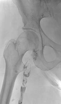 Xray of pre-treatment.