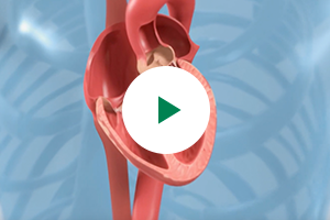 Severe aortic stenosis and your treatment options