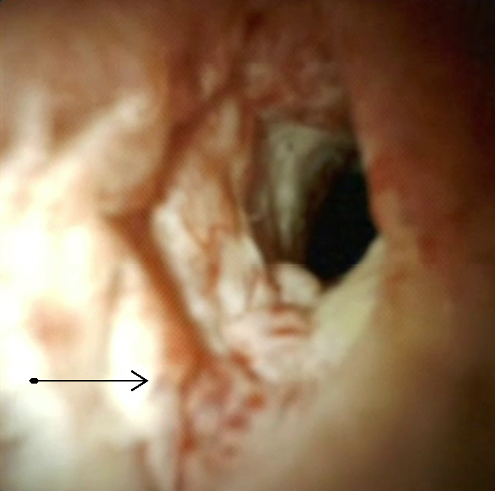 Clinical image of increased vascularity.