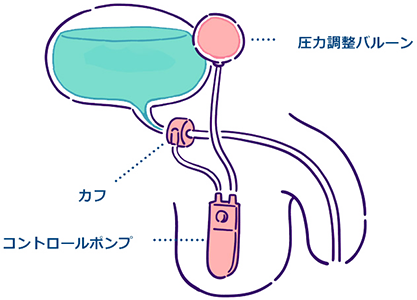 人工尿道括約筋