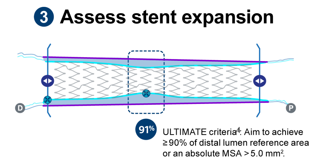 Illustration of a lesion where "a" shows the distal lumen reference, "b" shows the proximal lumen reference, and "c" shows under-expansion.