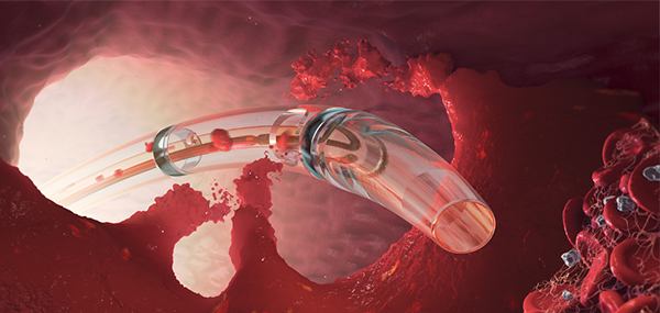 Zelantedvt catheter shown during procedure.