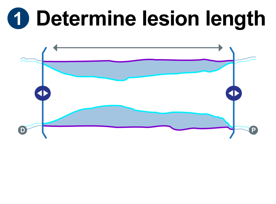 Illustration showing the sideways angle of a lesion and its length