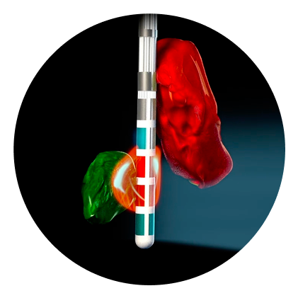 Close up of DBS lead with Illumina 3D activated.