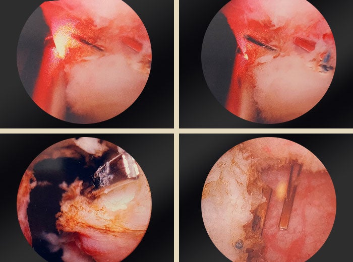4 individual shots of an OR camera zoomed into prostate.