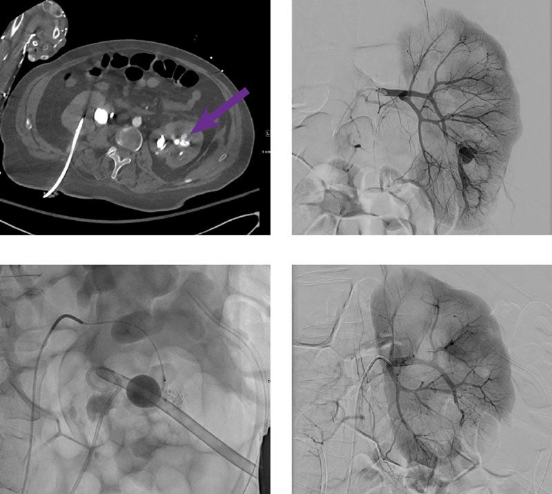 Post-PCNL renal bleed embolization Obsidio™ Case Study - Boston Scientific
