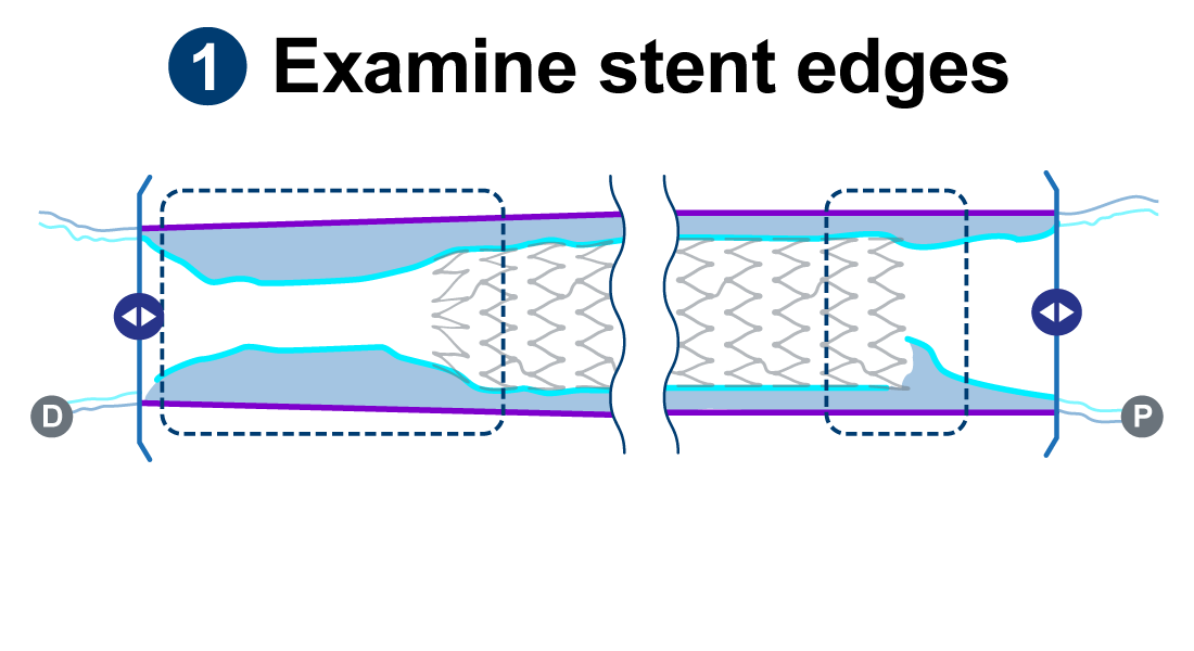 Graphic showing geographic miss of a lesion, Graphic showing edge dissection of a lesion.