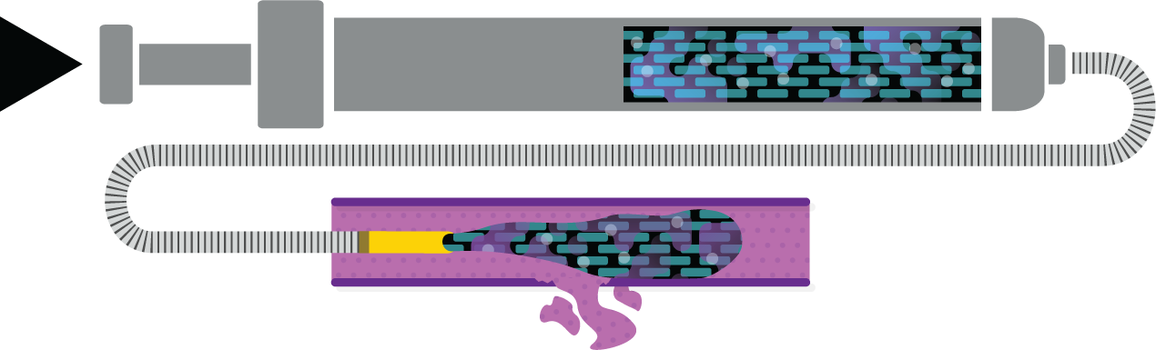 Obsidio Conformable Embolic liquid.