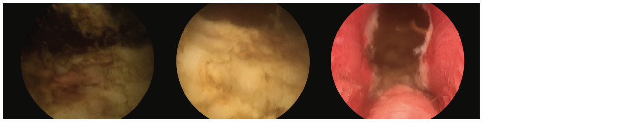 Additional 3 scope images. Identifying verumontanum. 