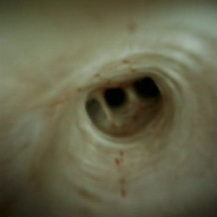 Clinical image of common hepatic duct.