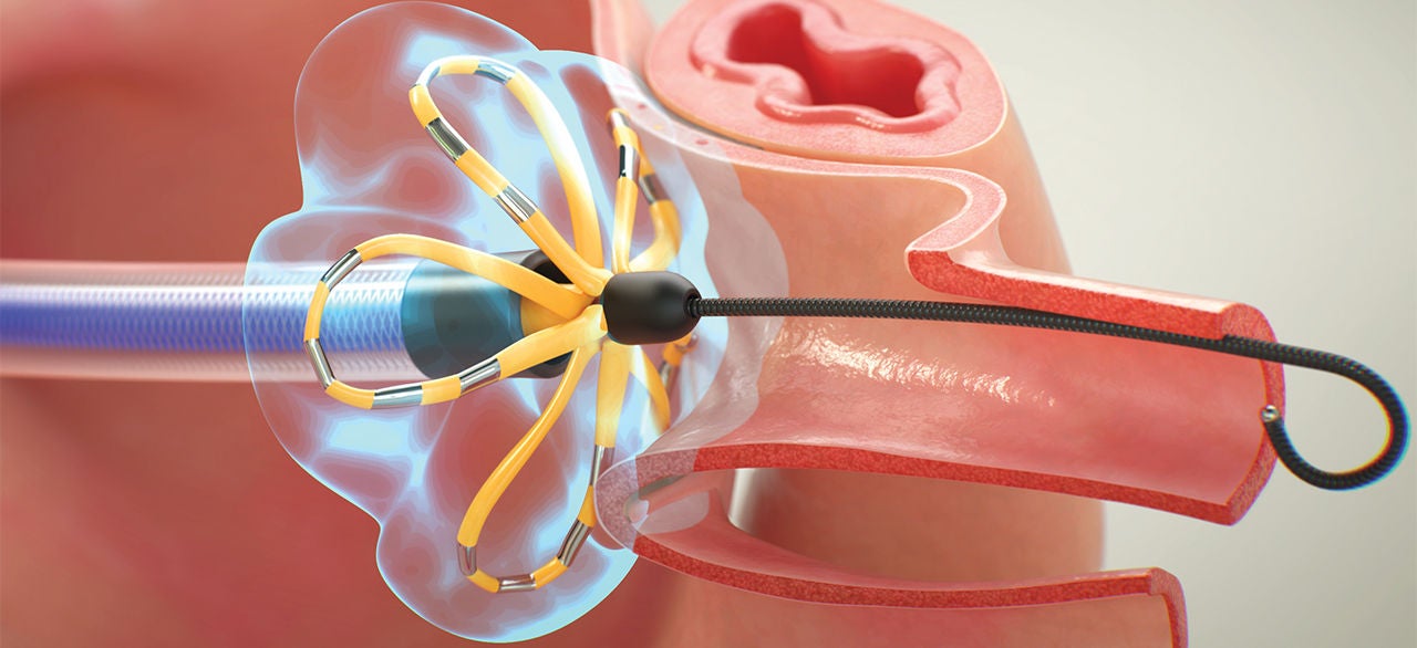 A medical illustration shows a catheter-like device inserted into a human nasal passage or sinus cavity.