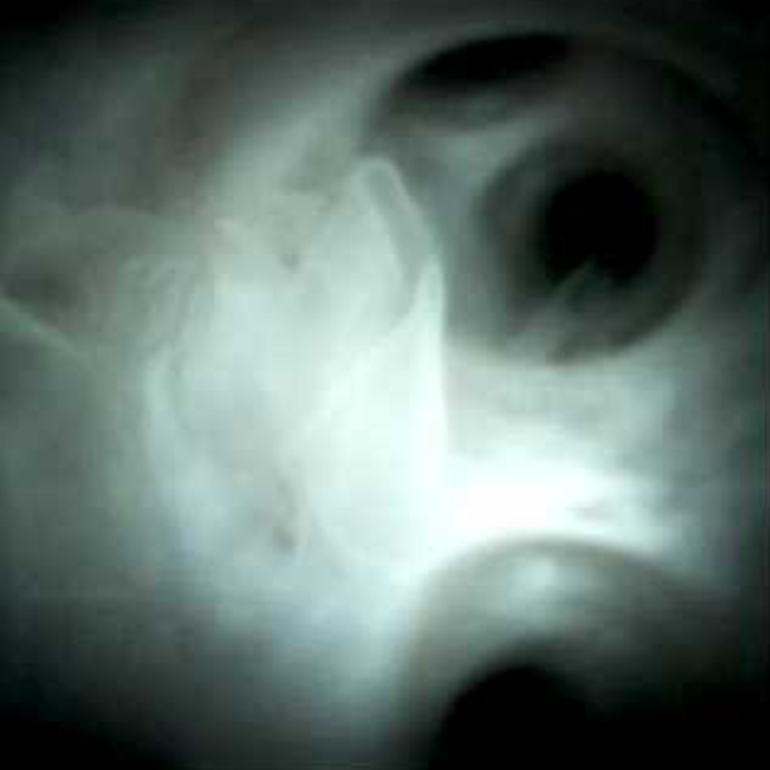 Clinical image of Desquamated epithelium II (DS I).