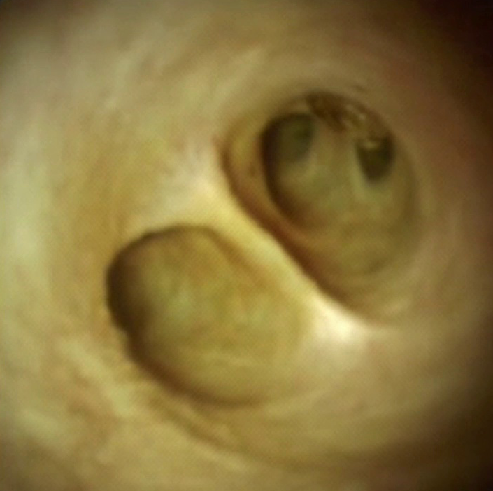 Clinical image of Intrahepatic ducts.