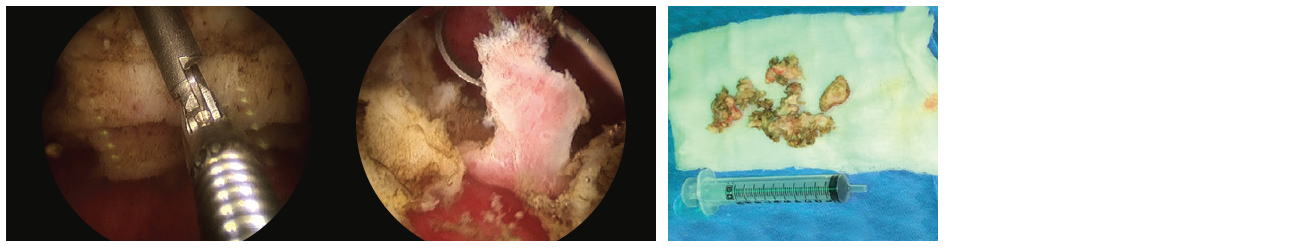 2 scope images, and a photograph of the excess material. Identifies the removal of excess.