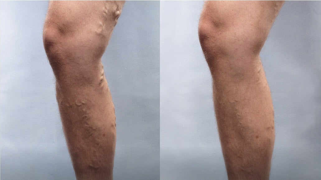 Side by side of two legs before and after Varithena treatment