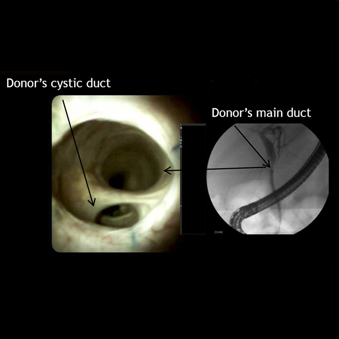 Clinical image of Biliary anastamosis four years (DS I).