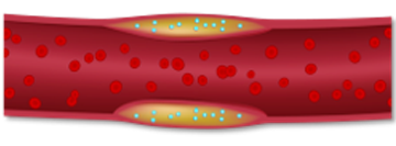 A scientific drawing of AGENT DCB in a vessel illustrating sustained retention. 