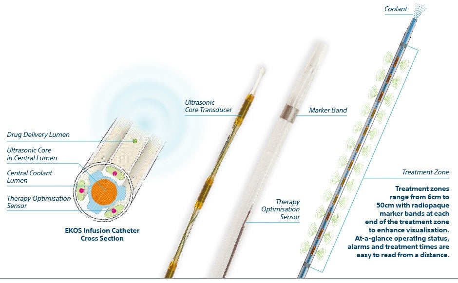 The EkoSonic™ Endovascular System includes an ultrasonic core within an infusion catheter, and control unit.