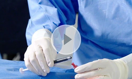 Gloved hands administering Obsidio Conformable Embolic.