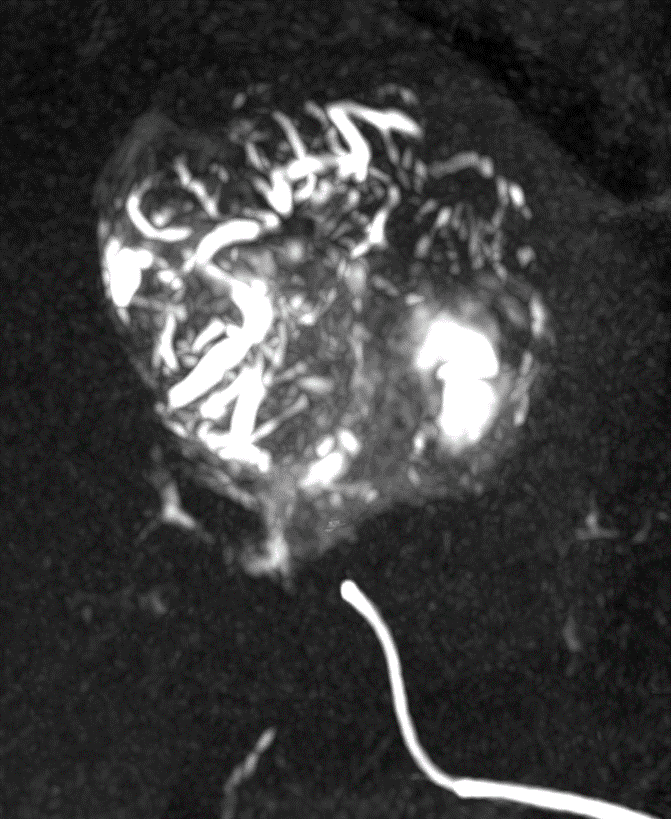 Vessels filled with beads clearly visible downstream of catheter placement