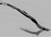 Thrombectomy of Left Brachial Artery-Axillary Vein Graft final result.
