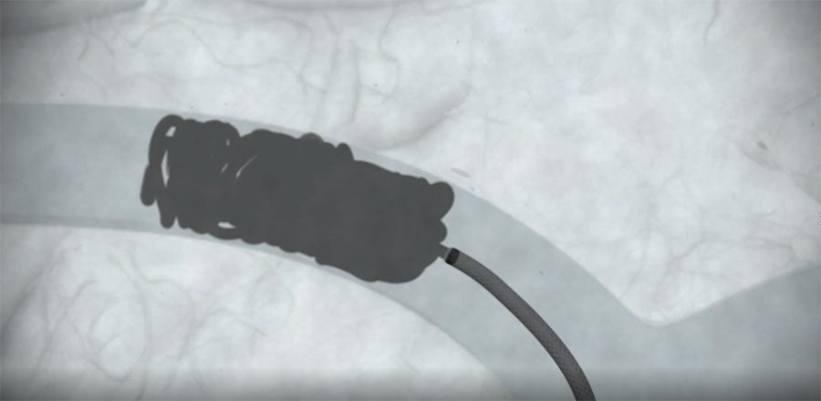 coil interting in vein