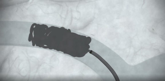 Embold Packing Coil - Embold™ Detachable Coil System - Boston Scientific
