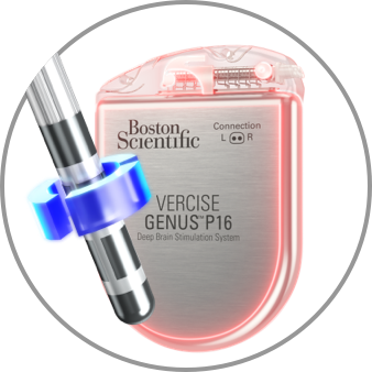 Two graphics showinganodic stimulation; one with a deep brain stimulation lead and the other with IPG.