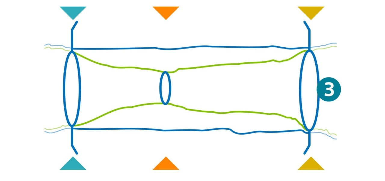Illustration showing the sideways angle of a lesion and the vessel size