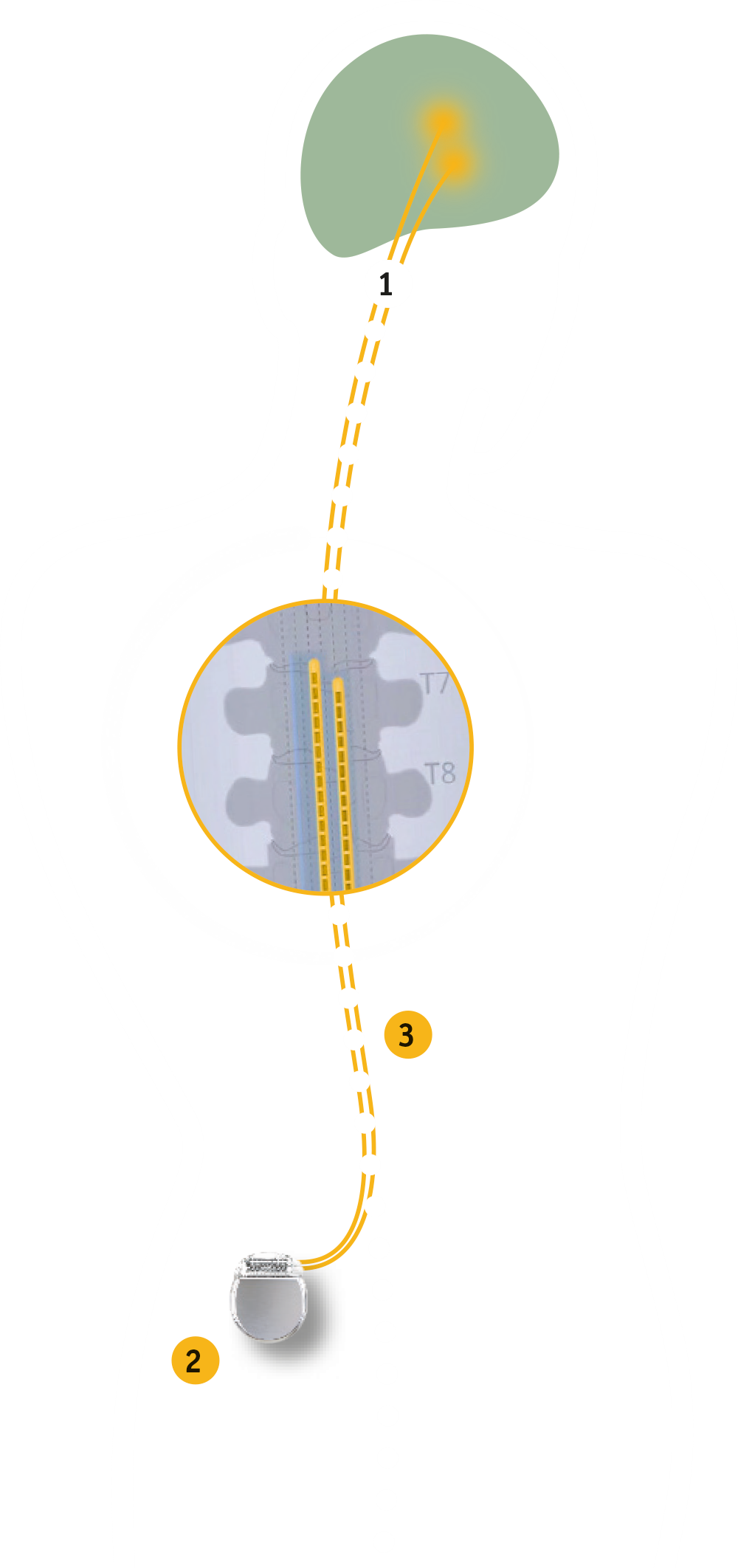 Spinal Cord Stimulation therapy follows three steps for implant and allows for the interruption of pain signals travelling to the brain.