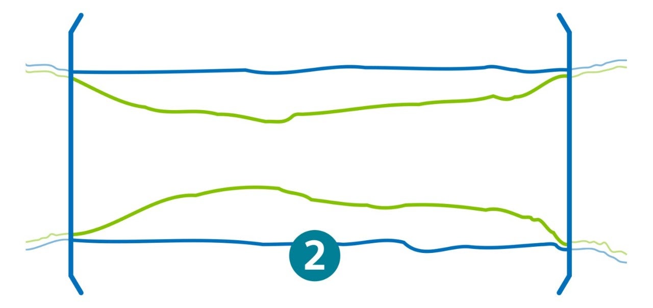 Illustration showing the sideways angle of a lesion and the type of plaque