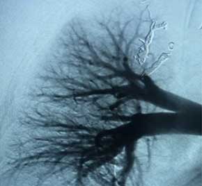 Scan of vein after Embold fibered coil.