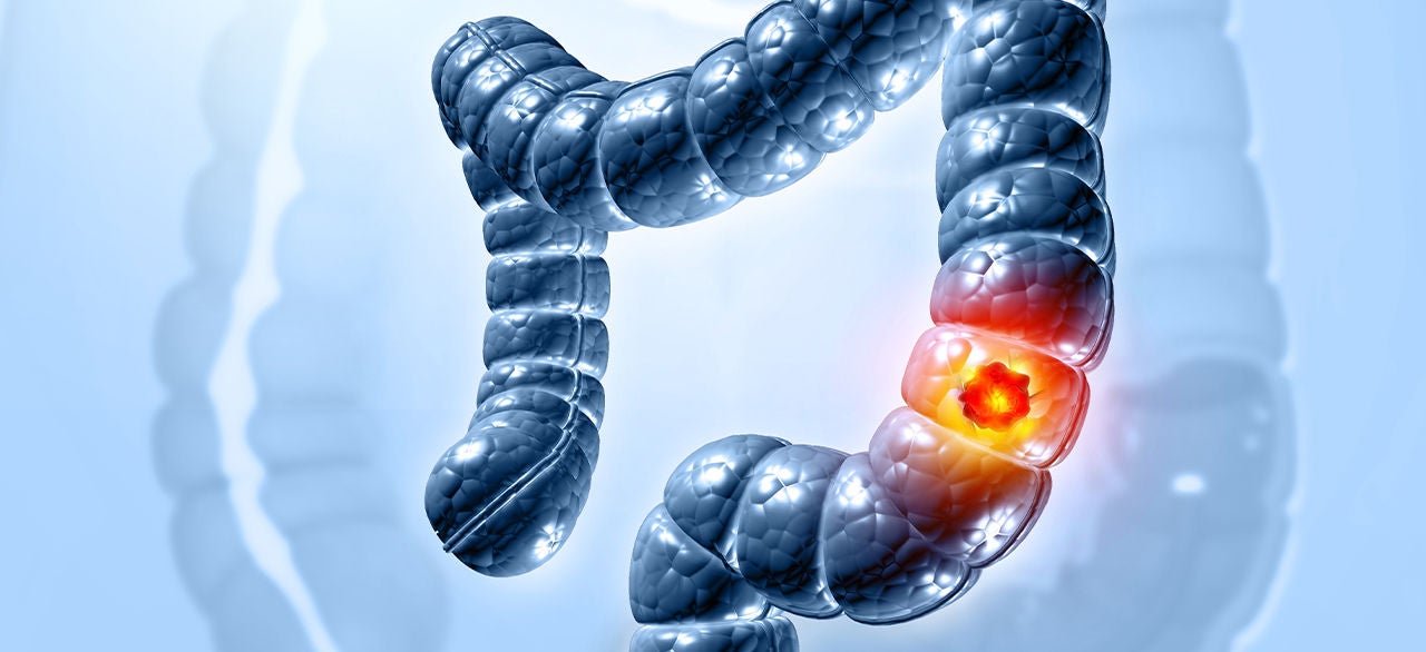 Medical 3D illustration showing a section of the human colon. A bright red and yellow highlighted area indicates a tumor or lesion within the intestinal wall. 