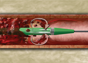Catheter moving through thrombus  in vein.