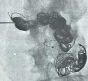 Scan of vein after Embold fibered coil.