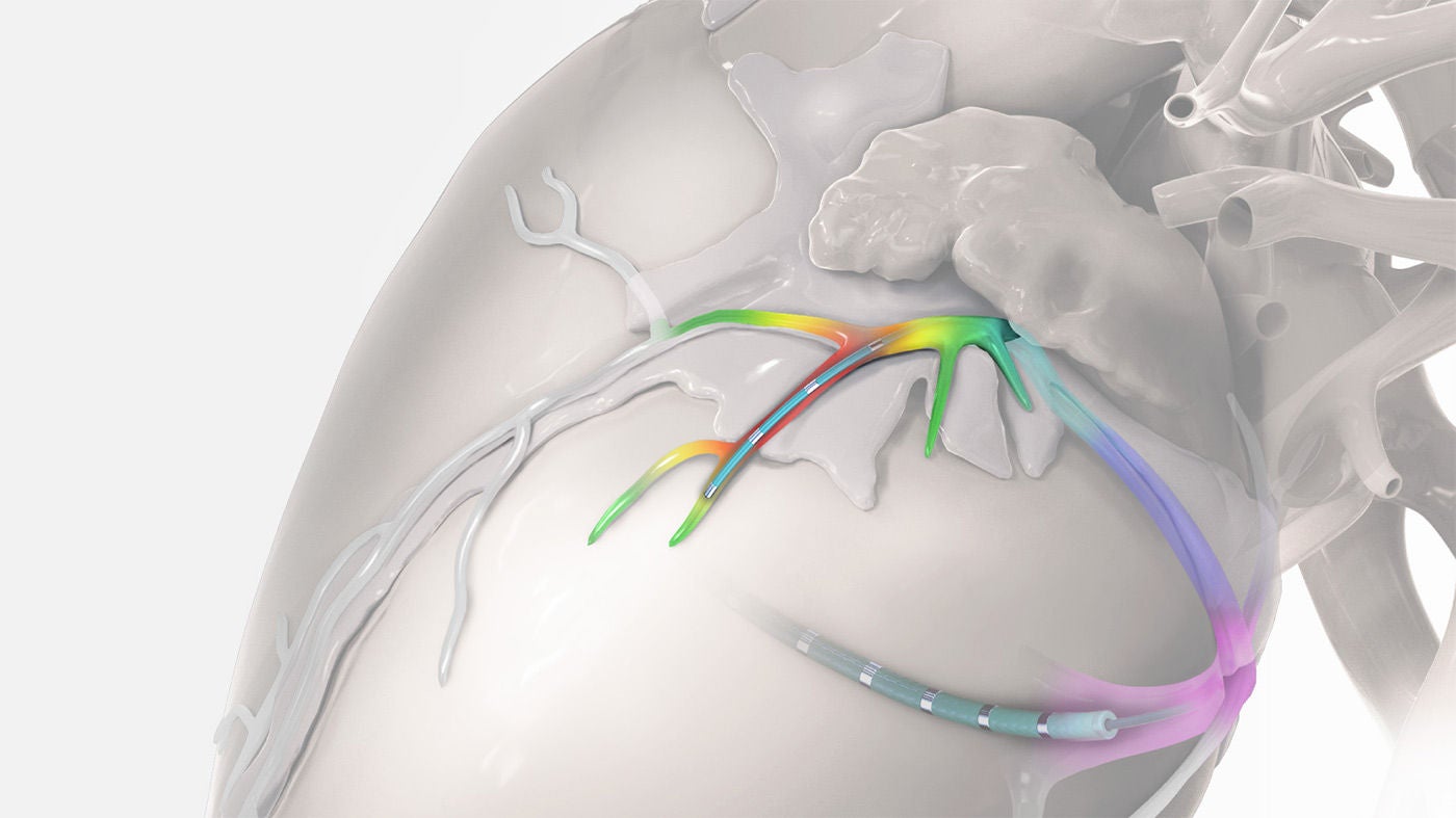 2F microcatheter telescoping out of 6F catheter with lumen into deeper coronary venous anatomy.