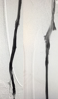 Xray of veins post-ZelanteDVT mechanical thrombectomy.