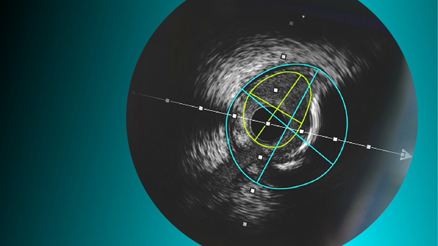IVUS device clinical study