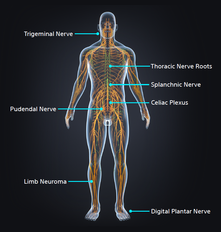 body outline with points showing nerve targets.