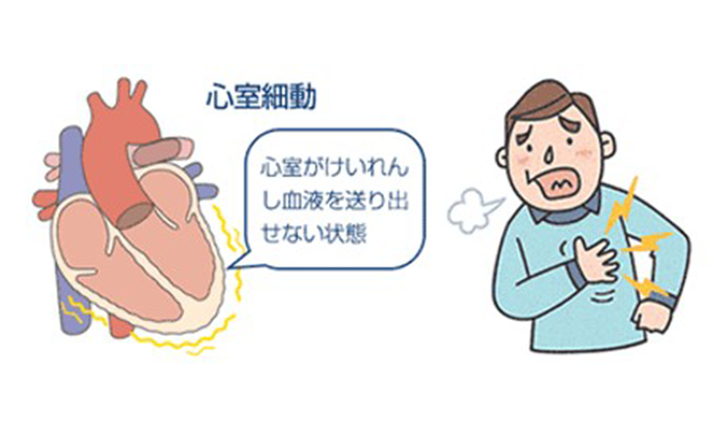 心房細動　心室がけいれんし血液を送り出せない状態