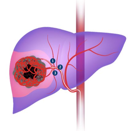 TheraSphereTM’s delivery allows for selective administration, offering simple dosimetry and minimizing normal tissue exposure