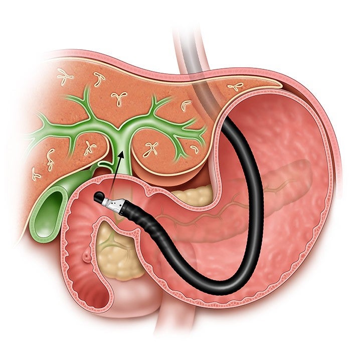 Cholecdocduodenostomy
