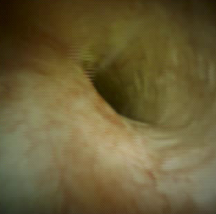 Clinical image of normal vascular patterns.