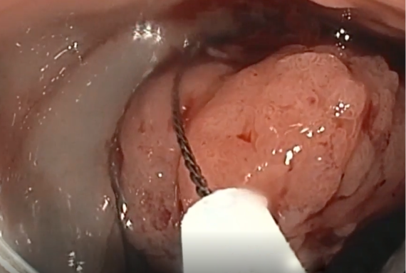 two health care professionals viewing endoscopic mucosal resection (EMR)