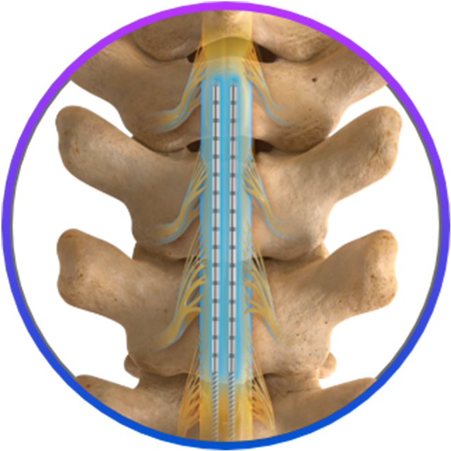Graphic depicting Infinion Pro Percutaneous Leads on a spine