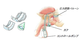 前立腺全摘後の尿失禁・治療法