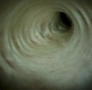 Clinical image of shallow decompressions.