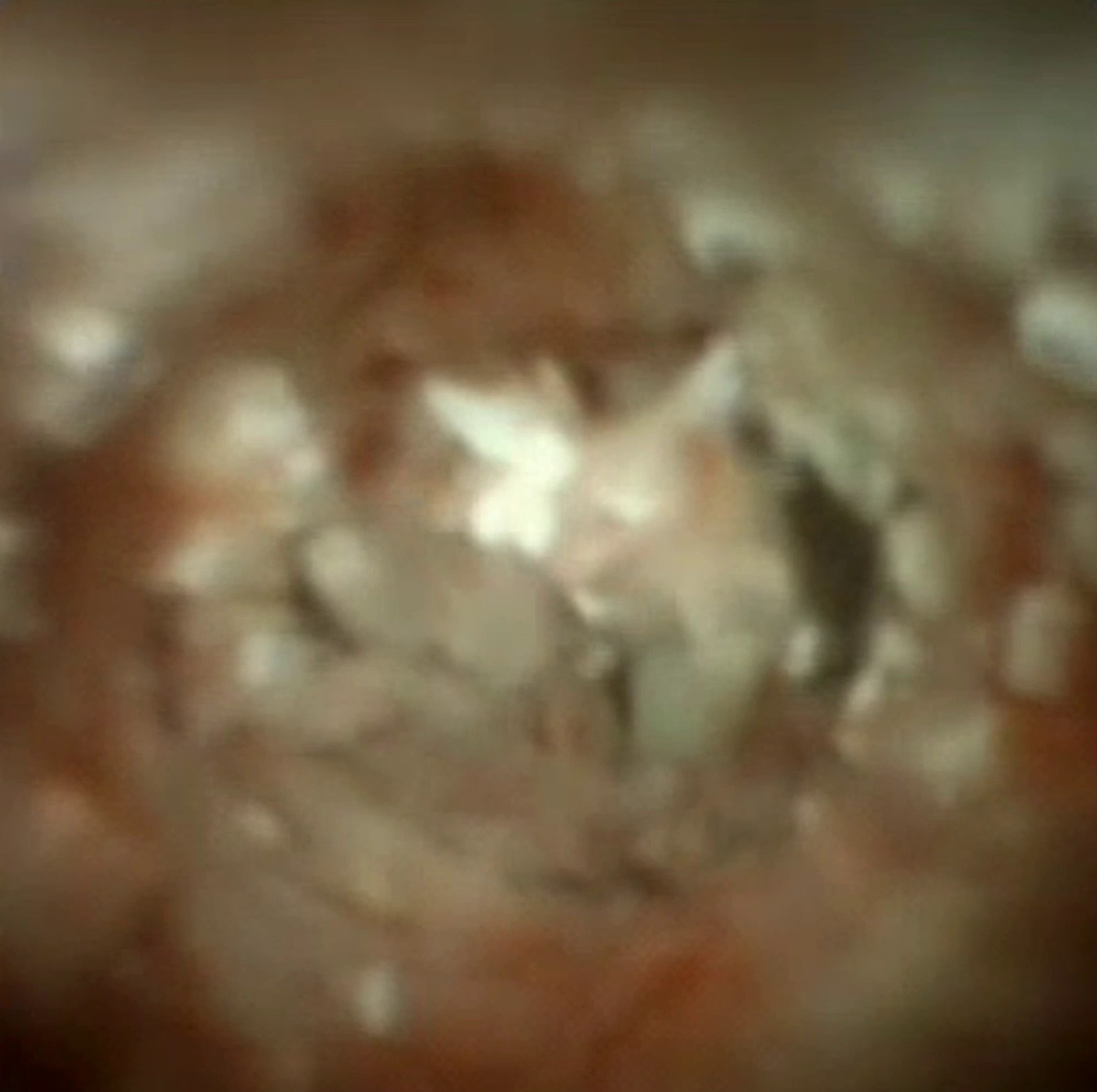 Clinical image of chronic calcific pancreatitis.